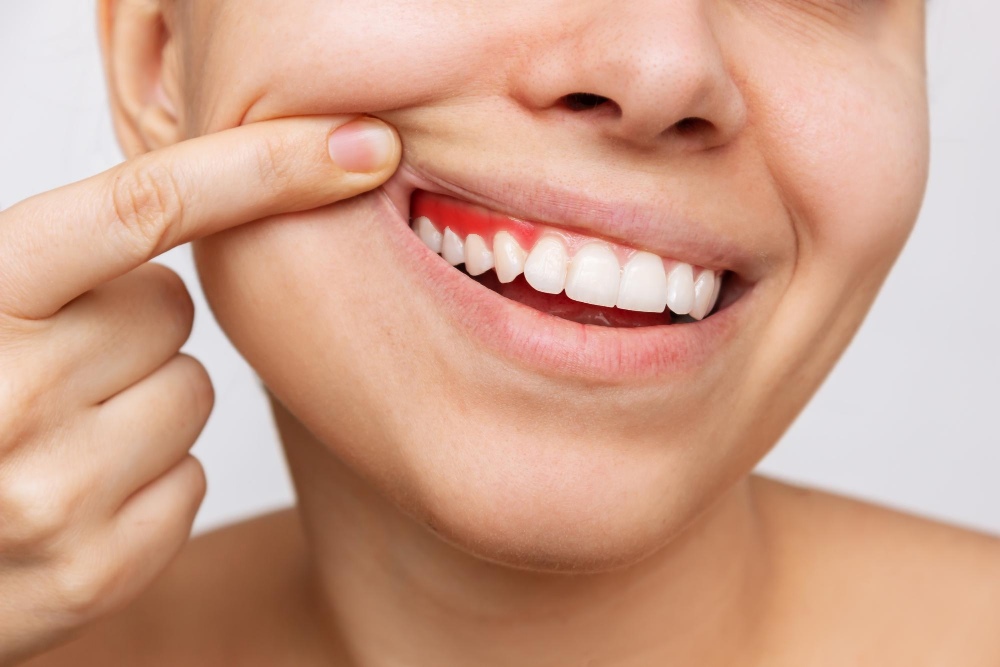 Si dice Parodontite o Piorrea? – Studio Dentistico vicino ad Acilia